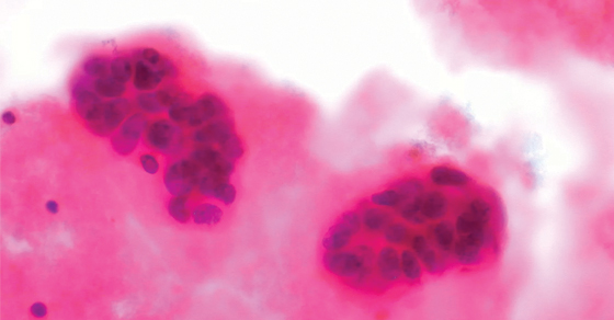 150915-origem-celular-cancer