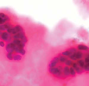 Pesquisas avançam e chegam à origem celular do câncer de mama