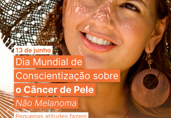 O câncer de pele não melanoma é o tipo de câncer mais comum no Brasil e representa cerca de 30% dos tumores malignos registrados no país. Quando diagnosticado precocemente, as chances de cura são muito altas.  Neste Dia Global de Conscientização sobre o Câncer de Pele Não Melanoma, reforçamos a importância da prevenção e do diagnóstico precoce. Fique atento a sinais como:  ✔️ Feridas que não cicatrizam  ✔️ Lesões que sangram com facilidade  ✔️ Manchas ou alterações persistentes na pele 🧴🩷 O uso diário de protetor solar, além de chapéus, roupas adequadas e a busca por sombra nos horários de maior incidência solar, são hábitos que ajudam a proteger a sua saúde. Compartilhe esta informação e ajude a ampliar a conscientização. 💙 #cancerdepele #cancerdepelenaomelanoma #conscientizacao #prevencao #saudedapele #diagnosticoprecoce